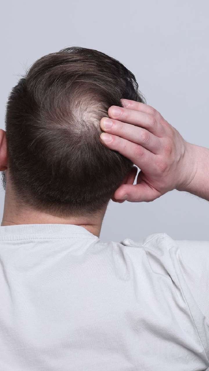 The Art and Science of Hairline Restoration